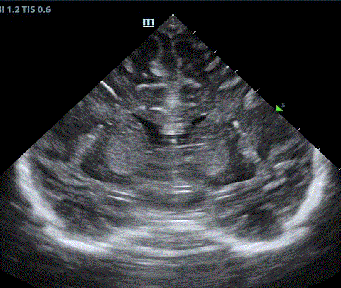   Coronal image after 6 weeks of thiamine supplementation shows caudate is less swollen and less echogenic. 