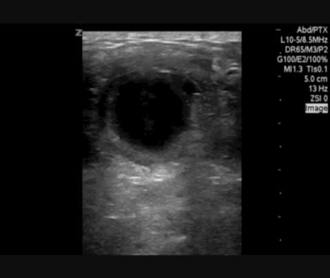  Ultrasound of umbilical hernia site. 