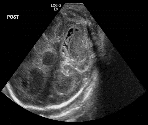  Coronal head ultrasound 