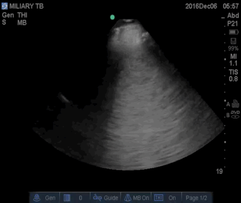  Bilateral long axis views of the lung with the low frequency probe. 