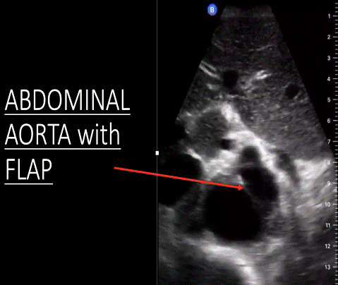 “Aortic Dissection” on eScholarship