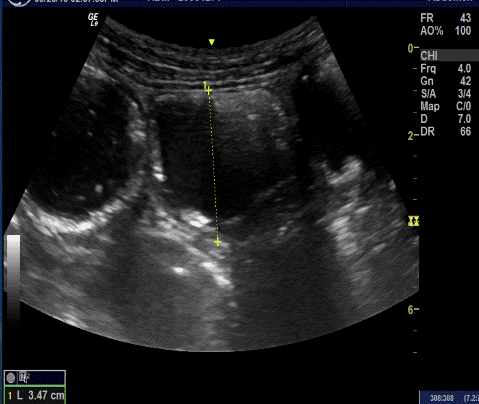 Pneumatosis Ultrasound