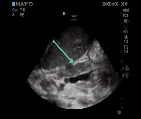  Transverse view of the proximal aorta demonstrating a single peri-aortic lymph node adjacent to the pancreas. 