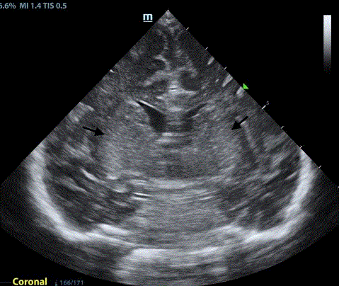  Coronal ultrasound shows hyperechoic putamina. 