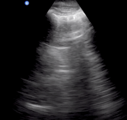 Apex of the left lung