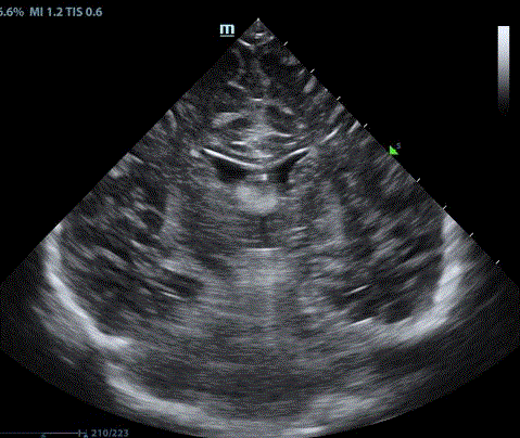  Coronal image demonstrates echogenic caudate nuclei compressing the lateral ventricles. 