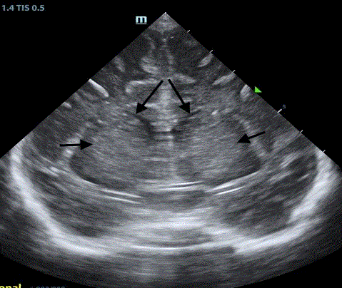  Coronal image demonstrates echogenic caudate nuclei compressing the lateral ventricles. 