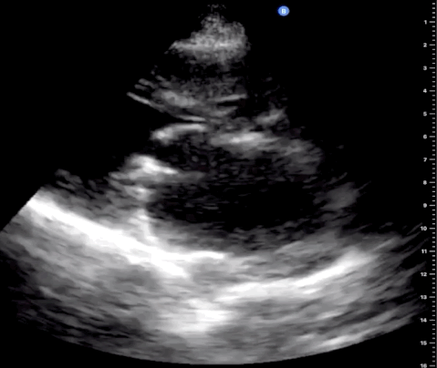  Trans-thoracic echocardiographic (TTE) parasternal long (PSL) view 