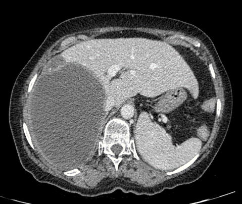 CT of the abdomen/pelvis