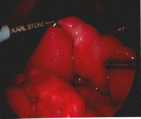  Intraoperative image demonstrates a loop of small bowel twisted around the mesentery. 