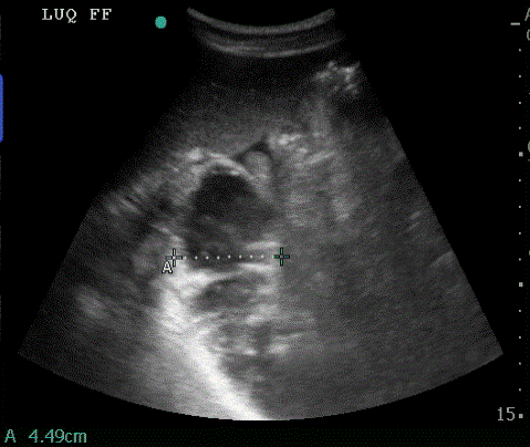  Dilated bowel noted in the left upper quadrant 