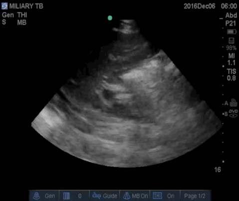  Left flank demonstrating a small left pleural effusion. 