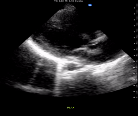 Parasternal long axis demonstrates a hyperdynamic heart with mild right ventricular dilation