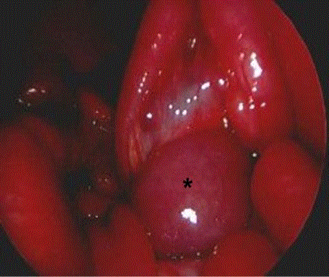  Intraoperative image shows a jejunal enteric duplication cyst (asterisk), likely the lead point of midgut volvulus 