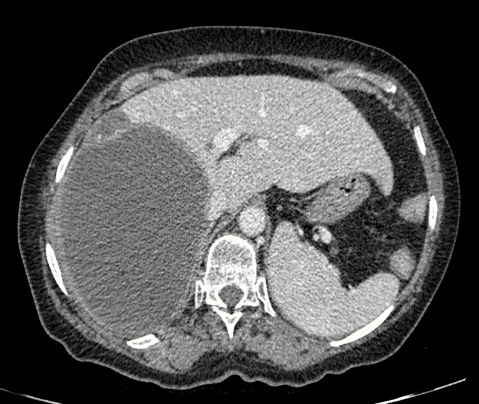 echinococcus granulosus liver