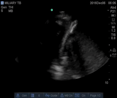  Right flank demonstrating a small pleural effusion and ascites. 