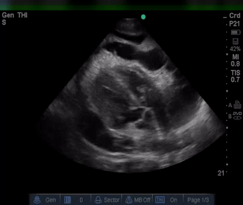  Subxiphoid view of the heart. 