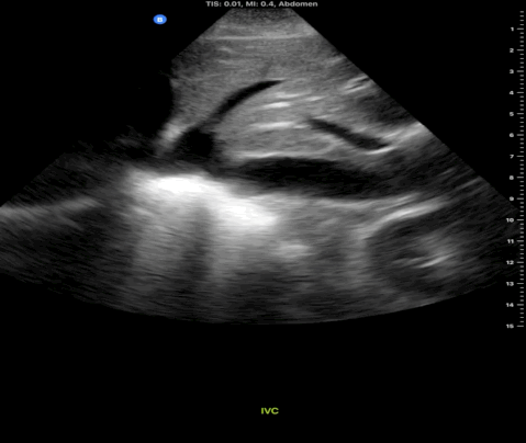 Subxiphoid view