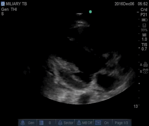  Parasternal long view of the heart demonstrating normal left ventricular systolic function and no apparent pericardial effusion. 