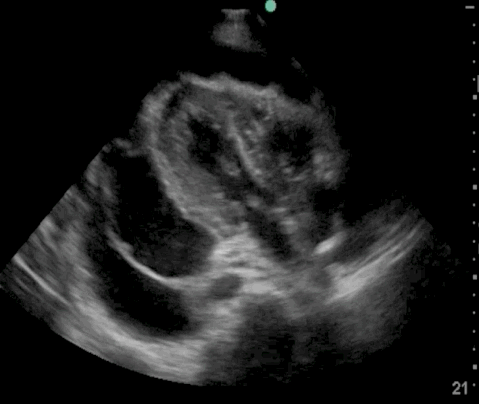  Subxiphoid view. 