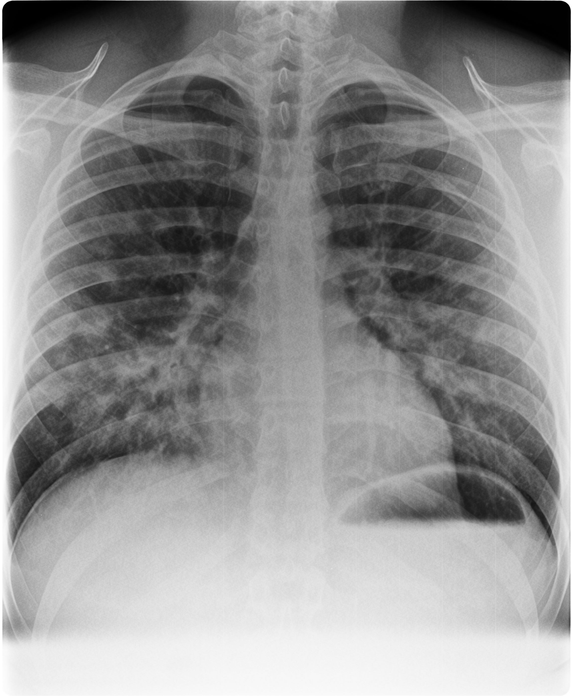 radiografía de edema pulmonar