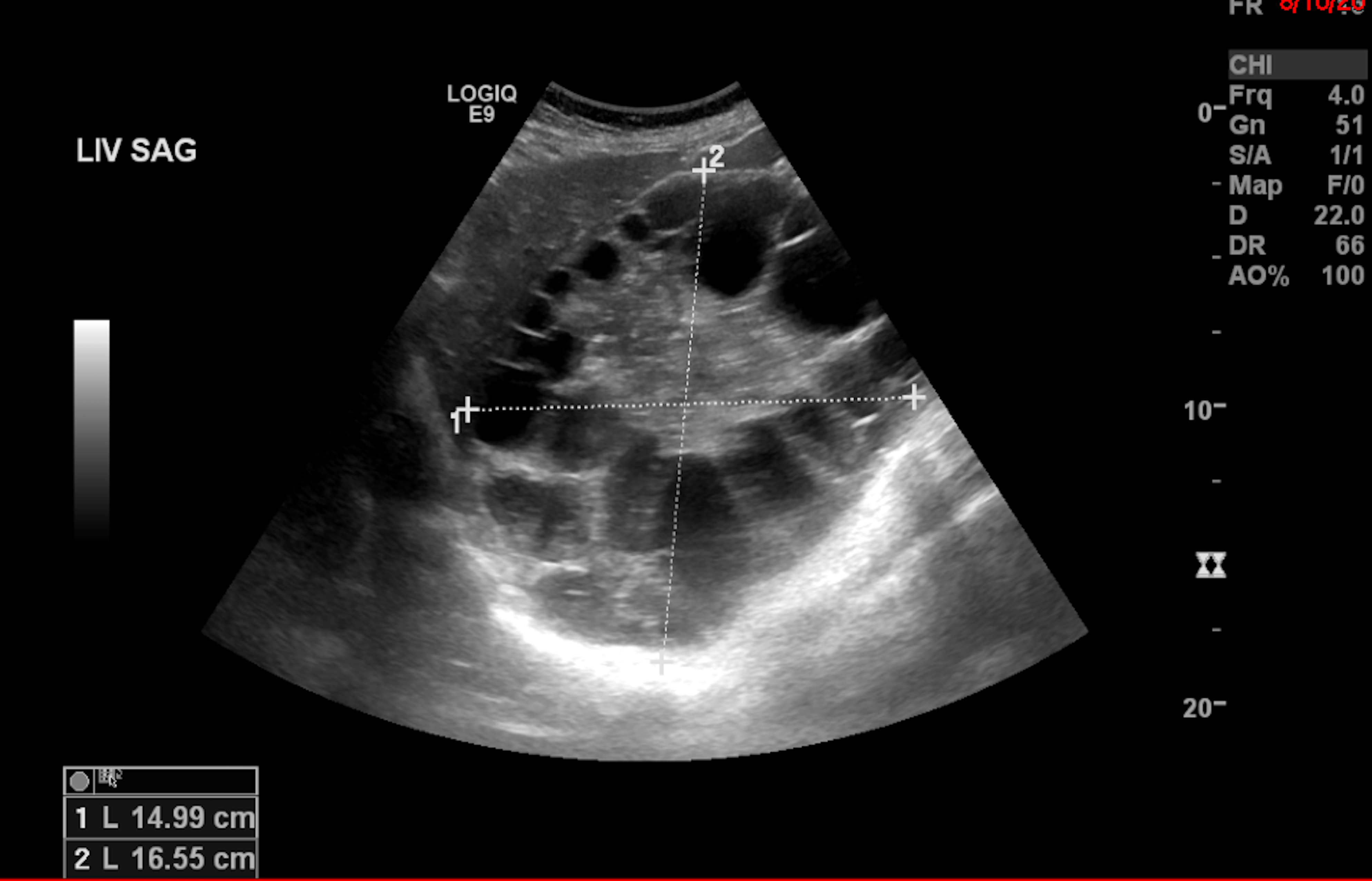 Hydatid Cyst Image 1 Ultrasound In Resource Limited Settings A Case