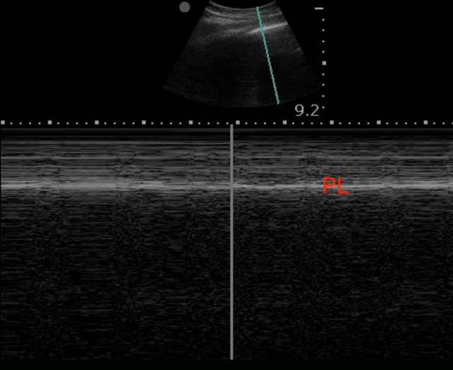 picture of pneumothorax m mode ultrasound