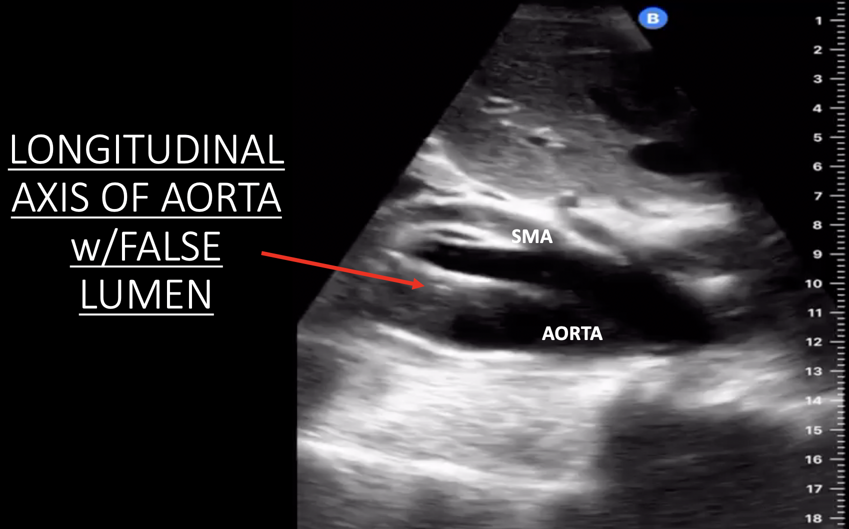 Aortic Dissection Annotated Still Image 4 Longitudinal Abdominal