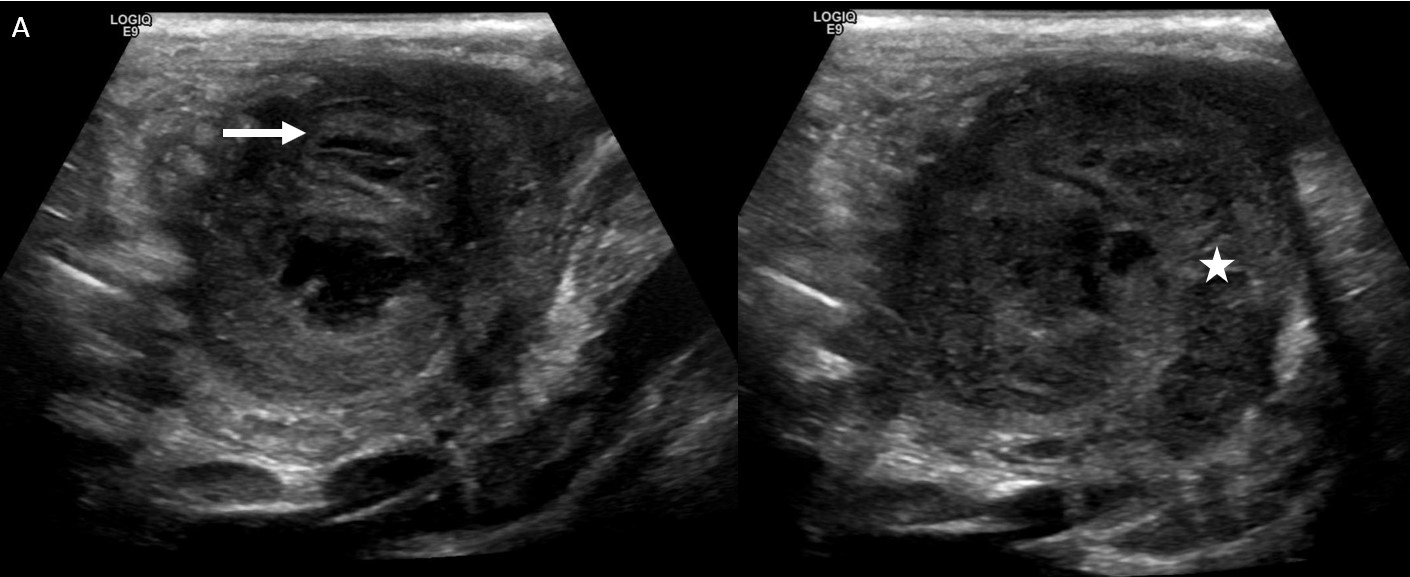 Perforated Appendicitis Image 1 Ultrasound In Resource Limited