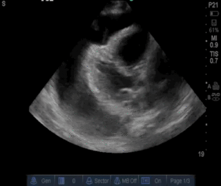 Thumbnail image for Fibrose Endomiocárdica Tropical