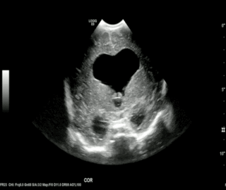 Thumbnail image for Hidrocefalia