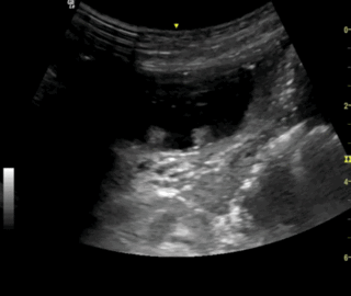 Thumbnail image for Small Bowel Obstruction and Pneumatosis Intestinalis