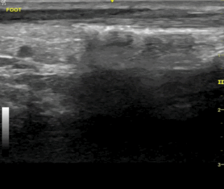 Thumbnail image for Necrotizing Soft Tissue Infection
