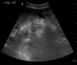 Thumbnail image for Typhoid Intestinal Perforation