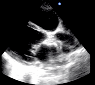 Thumbnail image for Cardiomyopathie du Peripartum