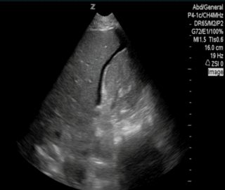 Thumbnail image for Ruptura de Embarazo Ectópico