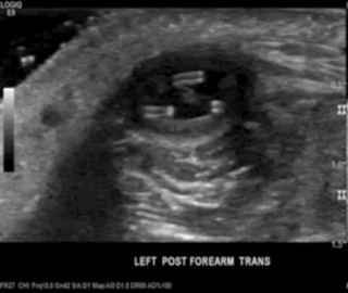 Thumbnail image for Dirofilariasis humana
