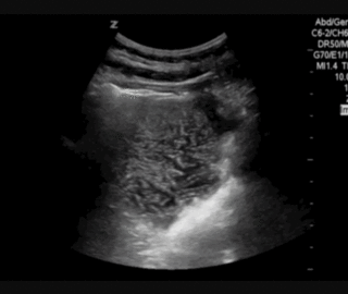 Thumbnail image for Strangulated Umbilical Hernia