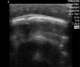 Thumbnail image for Pediatric Skull Fractures