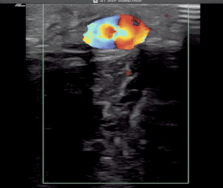 Thumbnail image for Arterial-Venous Fistula: An A&amp;E case from Masaka, Uganda