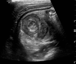 Thumbnail image for Appendico-cecocolic Intussusception