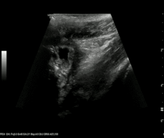 Thumbnail image for Perforated Appendicitis
