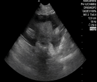 Cover of Ruptured Ectopic Pregnancy
