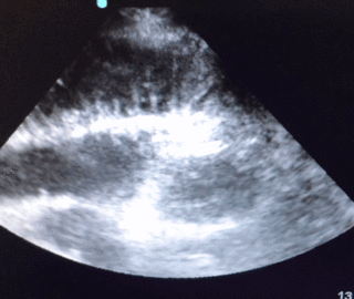 Thumbnail image for Diagnóstico de Obstrução Intestinal Alta &amp; Pneumatose Intestinal com Ultrassonografia à Beira do Leito