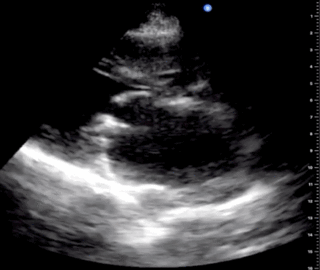 Thumbnail image for Cardiopathie Rhumatismale