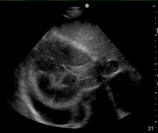 Thumbnail image for Péricardite Tuberculeuse