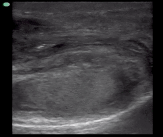 Thumbnail image for Fournier's Gangrene