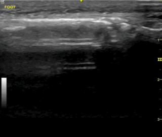 Thumbnail image for Infection Nécrosante des Tissus Mous