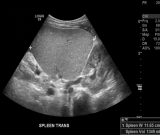 Thumbnail image for Esplenomegalia Palúdica Hiperreactiva