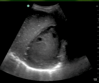 Thumbnail image for Absceso Hepatico Amebiano